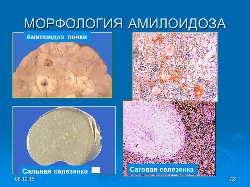 МОРФОЛОГИЯ АМИЛОИДОЗА 08:12:02 72 Сальная селезенка Саговая селезенка Амилоидоз почки